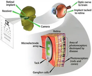 Fig. 6. Epiretinic implant: on a normal glasses is mounted a microcamera that supplies the  signals, this signals are transmitted to the chip through microcable in the eyes