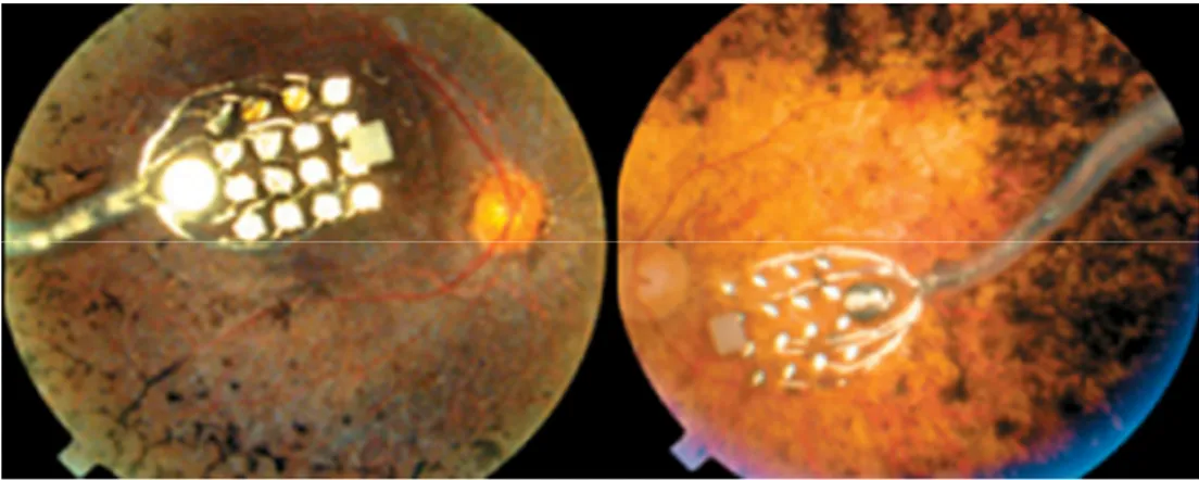 Fig. 7. Fundus photography showing an epiretinal electronic implant. 