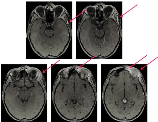 Fig. 4 RMN cranio e orbite:T1 Assiale con contrasto. Captazione del contrasto da parte del tessuto infiammato 