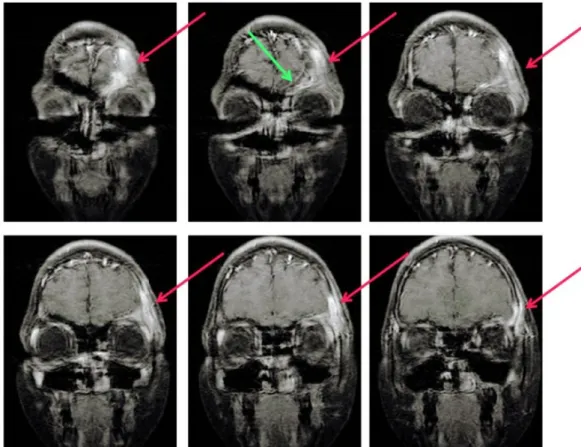 Fig. 5 RMN cranio e orbite: T1 coronale con contrasto Captazione del contrasto da parte del tessuto infiammato  Flogosi del seno frontale  