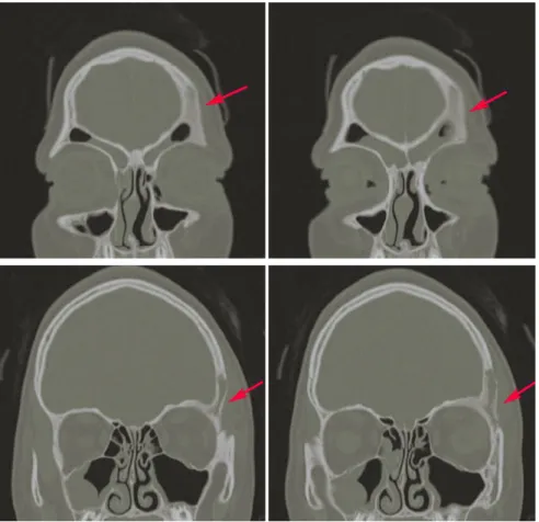 Fig. 15 TC cranio MPR Coronale  