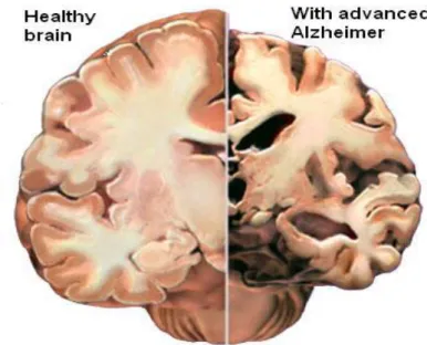 Figura 8. Sezione di un cervello sano (a destra) e sezione di un cervello  affetto da Alzheimer ( a sinistra)