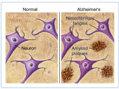 Figura 9. Placche β-amilodi che caratterizzano l’Alzheimer