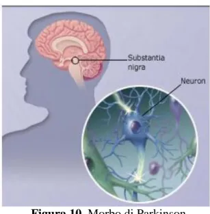 Figura 10. Morbo di Parkinson
