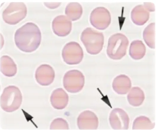 Figura  13  Stomatociti  in  striscio  periferico  di  cane  colorato  con  Wright  Giemsa  da  Laboratory  Urinalysis  and  Hematology for small animal practioners, C.Sink B