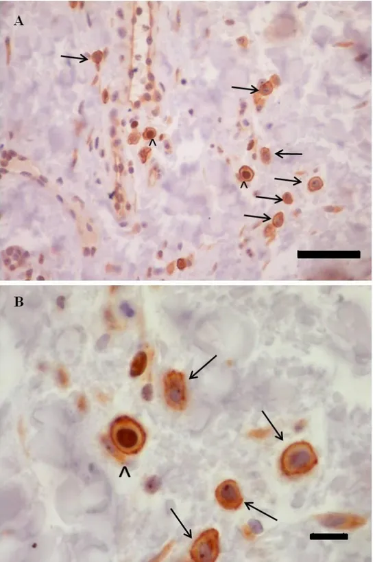 Figure  2:  Photomicrographs  showing  the  double-immunoreactivity  for  Ki67  (brown,)  and 