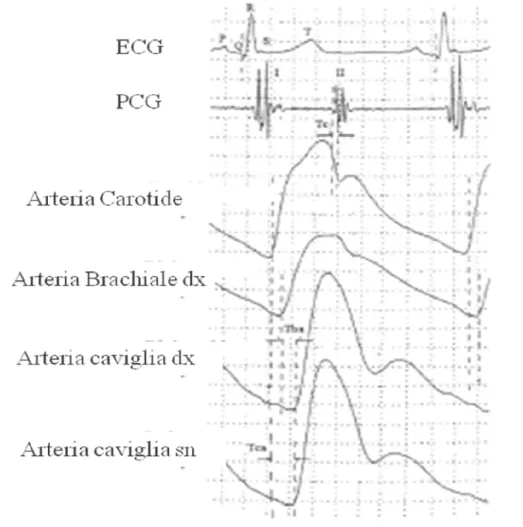 Fig. 2. Tba e (Tc+Tca) definiscono rispettivamente il tempo di transito braccio-caviglia e cuore-caviglia