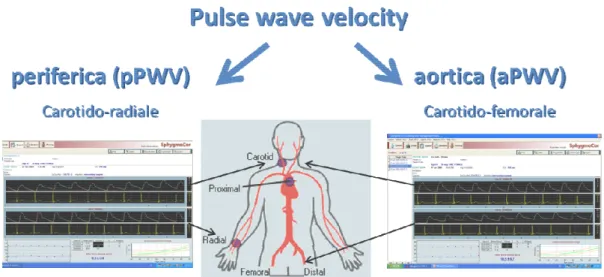 Figura  7.  PWV:  acquisizione  della  forma  d’onda  pressoria  in  maniera  sequenziale  a  livello  dell’arteria  carotide e radiale (periferica) e a livello dell’arteria carotide e femorale (aortica) mediante tonometria