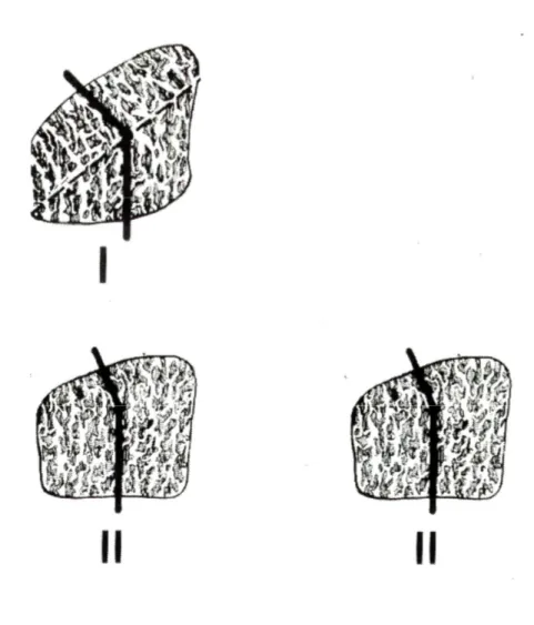 Fig. 2: Classificazione secondo Zapico delle diverse  morfologie del semilunare 