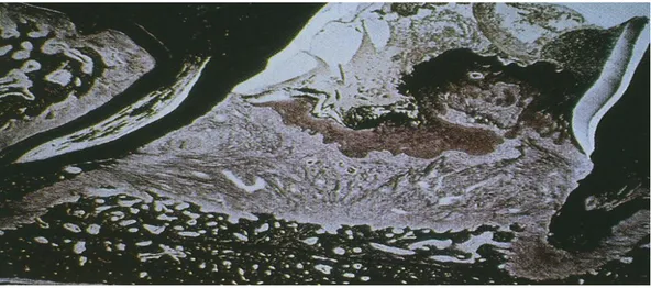 Fig. 4: tessuto di granulazione a 7 giorni dall’estrazione (Lindhe; Parodontologia e implantologia dentale, III edizione; 