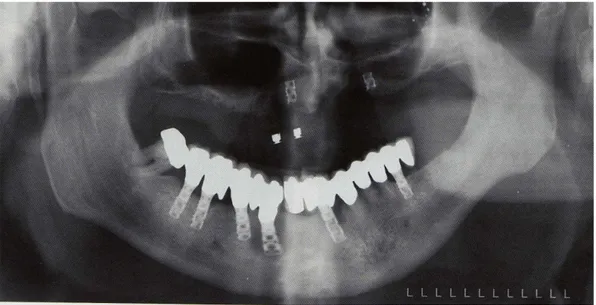Fig. 13  Ortopantomografia che mostra un fallimento implantare conclamato da overloading, misfit e  sovrainfezione  batterica (da “Implantologia” Masson 2009) 