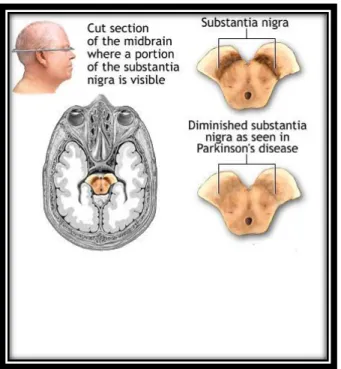 Figura 12.Differenze relative alla sostanza &#34;nigra&#34; in un cervello sano (sopra) e in uno malato (sotto)