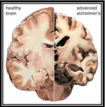 Figura 13.Sezione di un cervello sano (destra) e sezione di un cervello affetto da AD (sinistra)