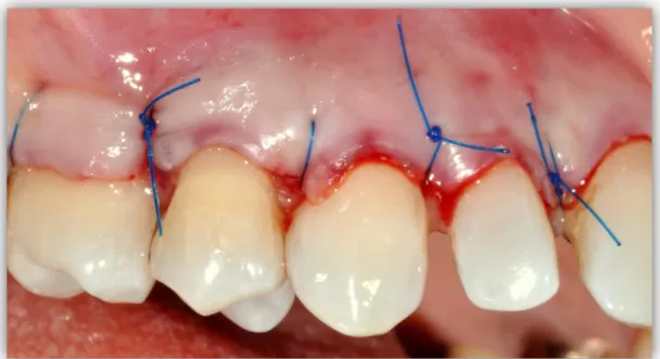 Figura 14: foto intraoperatoria: sutura del lembo 