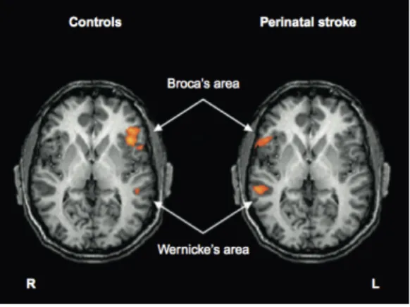 Fig. 2.2 Language representation in patients with  left  perinatal  stroke  and  right-hemispheric  reorganization  of  language