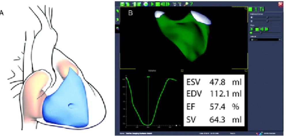 Fig. 6 (A) la complessa geometria del ventricolo destro. (B) ricostruzione della cavità ventricolare destra usando TomTec  analytical software