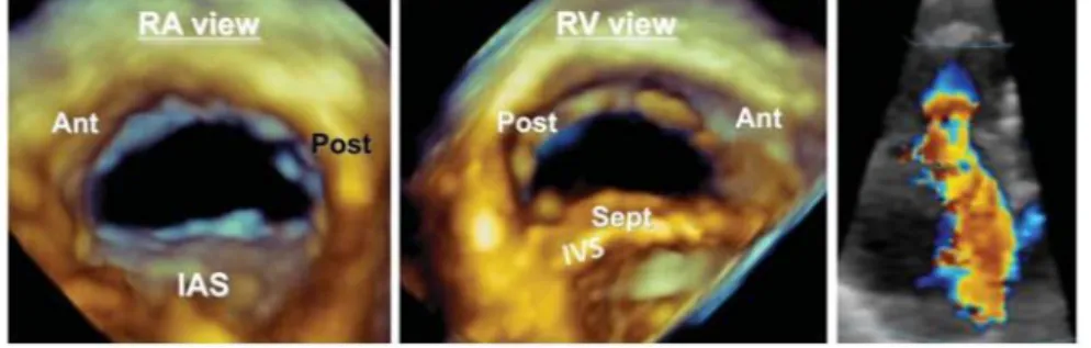 Fig.  8 Immagini con TEE 3D della valvola valvola tricuspide dall’atrio destro (a sinistra), dal ventricolo destro (in  mezzo)