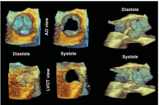 Figura 9:  immagini TEE 3D zoomed della valvola aortica vista dall’aorta ascendente (Ao) in diastole e in sistole e dal  tratto di efflusso del LV (LVOT) in diastole e in sistole