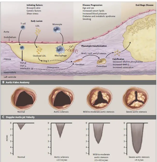 Figura  1  Rappresentazione  schematica  della  progressione  della  stenosi  aortica  calcifica