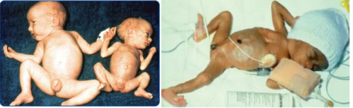 Figura 3: esempi di neonati a termine e pretermine piccoli per l’età gestazionale (3)
