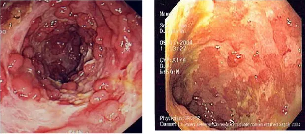 Figura 1.3 – Malattia di Crohn (sinistra) - Rettocolite ulcerosa (destra)