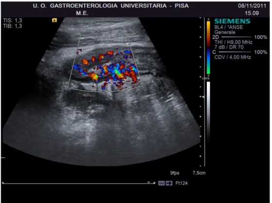 Figura 1.7 - Studio della vascolarizzazione della parete intestinale con CD in paziente affetto  da MC