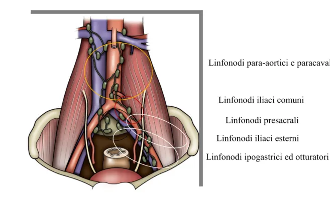 Fig. 7. Linfoadenectomia standard ed estesa. (modificata da Campbell-Walsh Urology)