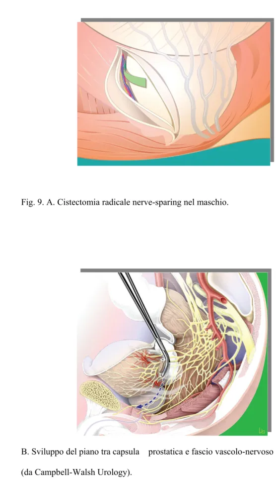 Fig. 9. A. Cistectomia radicale nerve-sparing nel maschio. 