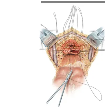 Fig. 11. La cupola vaginale viene chiusa effettuando una sutura continua. 