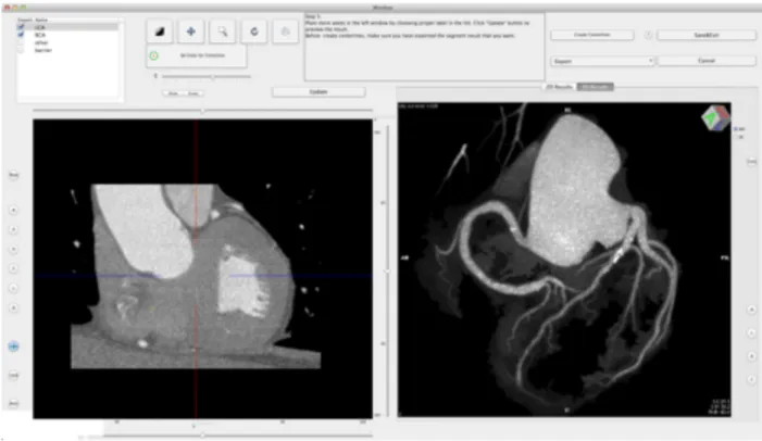 Fig.  1e.  The  CTA  CMIV  plugin:  panoramic  MIP  image  of  the  coronary  arteries  (frontal  view)  obtained from automatic segmentation inside the plugin environment.