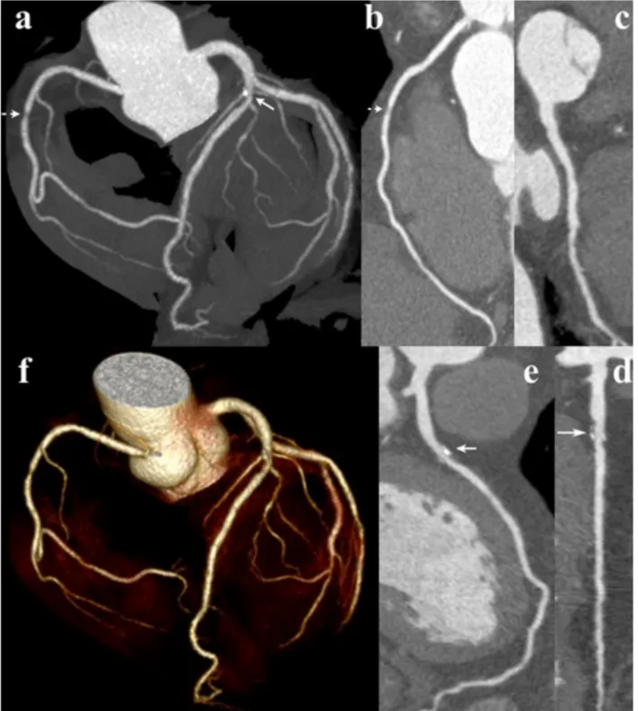 Fig. 4. Image quality of CTCA examination with the 100kV, low noise filter protocol in patient with  mild focal soft plaque of the RCA (dashed arrow) and segmental mixed plaque of the LAD (arrow)