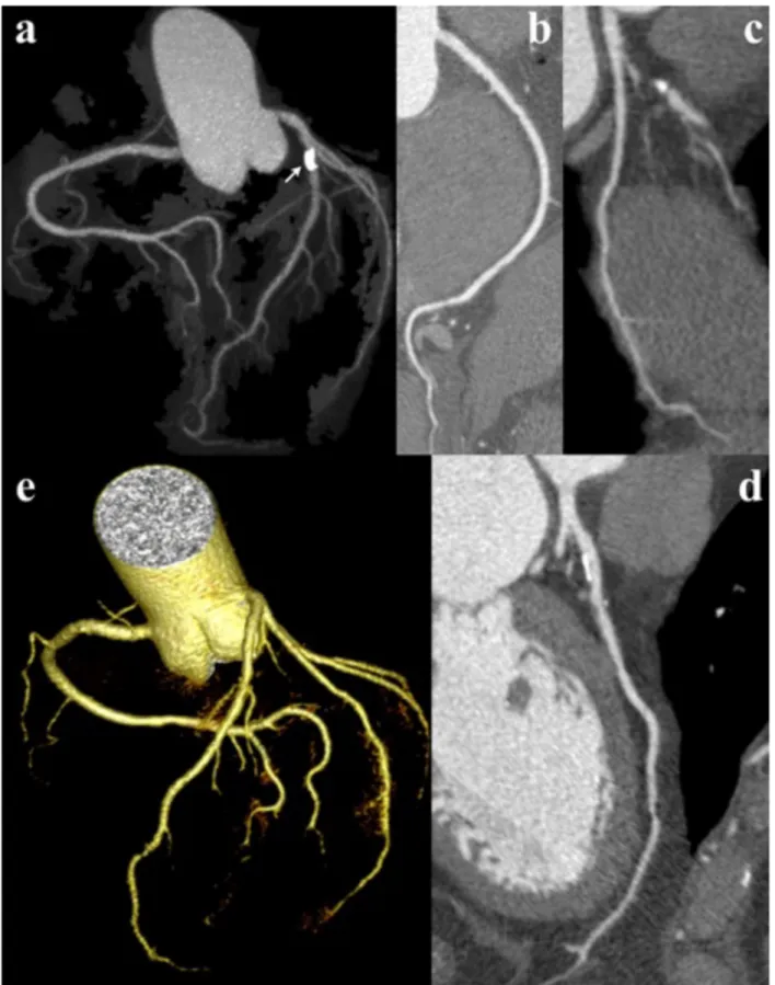 Fig. 5. Image quality of CTCA examination with the 120kV, standard filter protocol in patient with  mixed, mainly calcified plaque of the LAD (arrow)