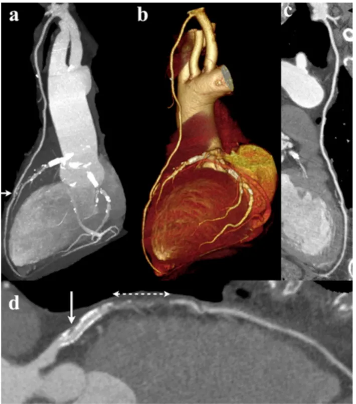 Fig. 6. Image quality of CTCA examination with the 100kV, low noise filter protocol in patient with  LIMA-LAD bypass graft (short  arrow indicates distal  anastomosis)  and  stenting  of proximal LAD  and RCA