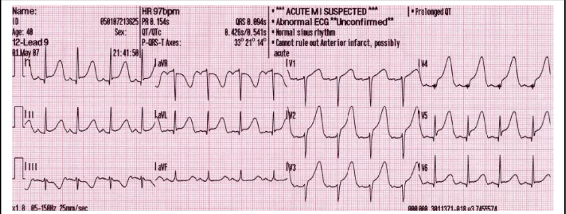 Figura 1.2.  Infarto miocardico anteriore esteso (STEMI): nelle vecchie classificazioni  veniva definito infarto sub-epicardico