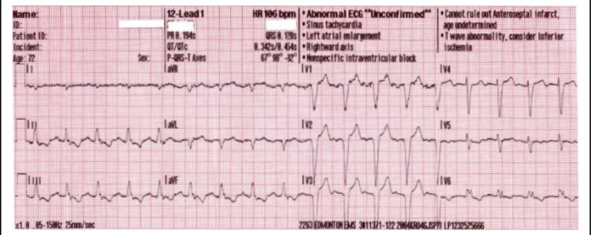 Figura   1.3.  Alterazioni   compatibili   con   ischemia   infero-laterale   (NSTEMI):   nelle  vecchie classificazioni veniva definito infarto sub endocardico