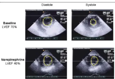 Figura  1  Riduzione  della  Frazione  di  eiezione  dopo  infusione  di  noradreanalina  in  un  paziente  con  shock  settico