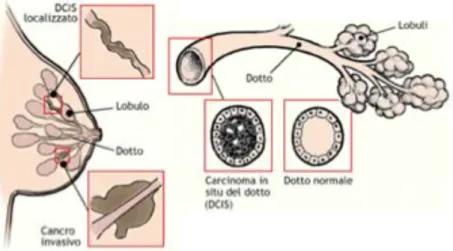 Figura 1.3: Esempio di carcinoma duttale in situ e infiltrante 