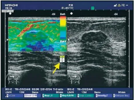 Figura 1.7: Monitor dell’ecografo in modalità dual: a sinistra il risultato  dell’elastografia rappresentato in scala di colore; a destra l’esame tradizionale 