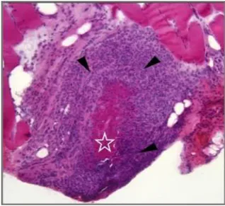 FIG. 2 Istologia di una biopsia muscolare che evidenzia vasculite con necrosi  fibrinoide della   parete vasale (stella) ed infiltrazione degli eosinofili (frecce)