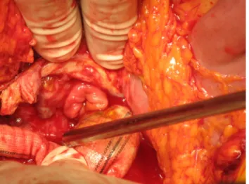 fig.  9:  fistola  aorto‐enterica  in  infezione  di  protesi vascolare aorto‐bisiliaca. 