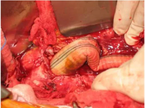 fig 17: protesi aorto bisiliaca infetta al momento dell’espianto 