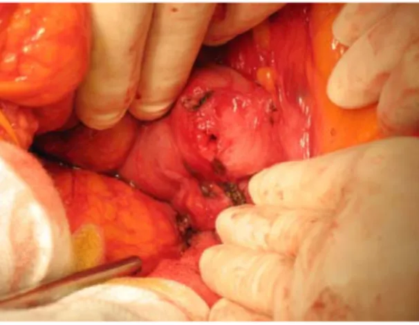 Fig. 1: Immagine intraoperatoria di fistola aorto‐enterica 