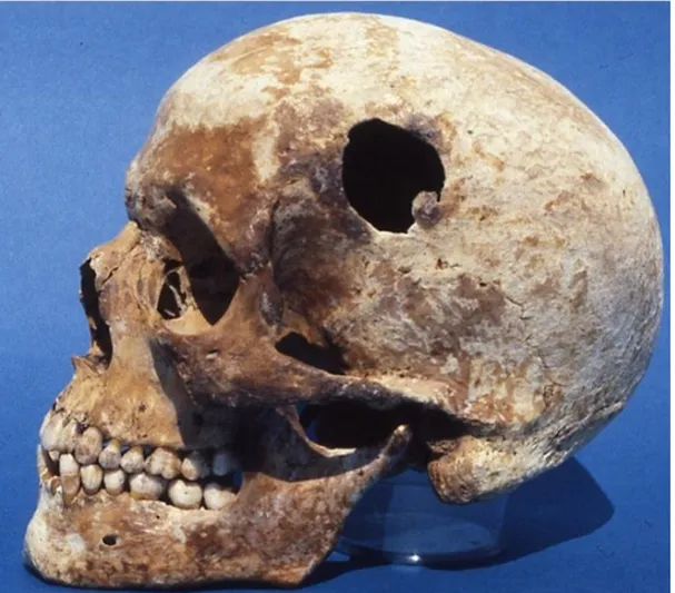 Figura 71: bc 01, Cranio con trapanazione.  