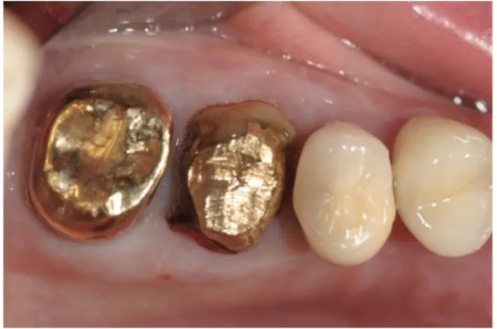 Figura  1.L'immagine    mostra  la  presenza  di  elementi  dentari  mesialmente e distalmente al dente da estrarre