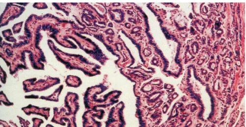 Fig. 4 - Carcinoma papillare variante classica 