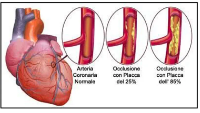 Figura 5:principali cause di insorgenza di ischemia cardiaca        