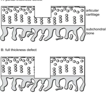 Figure 1.1.1: A partial thickness focal defect in articular cartilage (A) and a full thickness defect involving the subchondral bone (B).