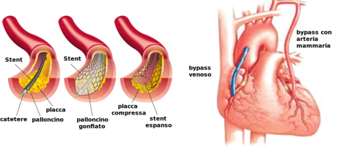 Figura 1.1: Esempi delle tecniche di angioplastica e di innesto di un bypass aortocoronarico