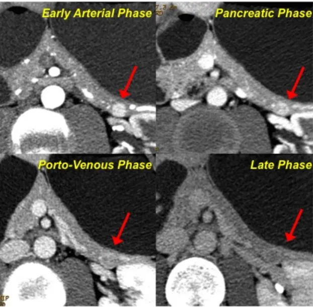 Fig.  2-Pattern  A.  After  contrast  medium  injection,  the  neuroendocrine  lesion located in the tail of the pancreas shows a vivacious enhancement  during  the  early  arterial  phase;  the  wash-in  is  still  evident  during  the  pancreatic phase, 