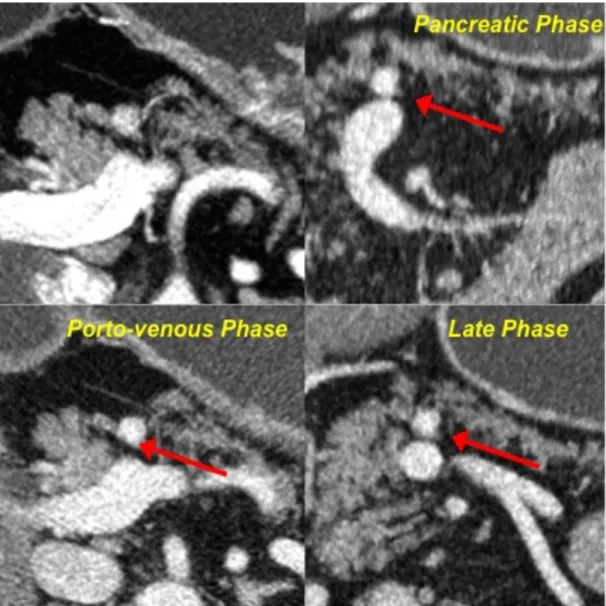 Fig. 3-Pattern B1. After contrast medium injection, the neuroendocrine  pancreatic  neoplasm  shows  vivacious  enhancement  yet  during  the  early  arterial  and  pancreatic  phase;  the  lesion  still  appears  as  hyperdense  in  respect to the surroun